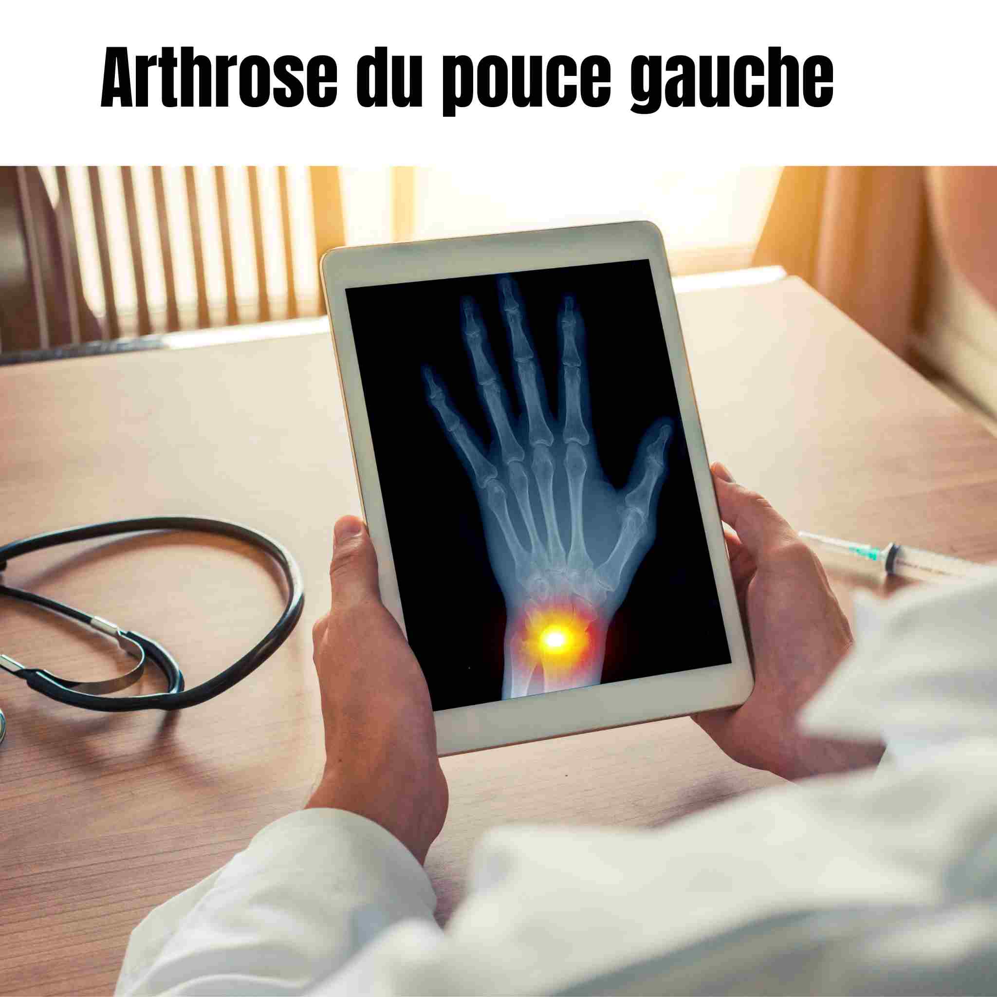 Arthrose du pouce gauche : comprendre, soulager, décider