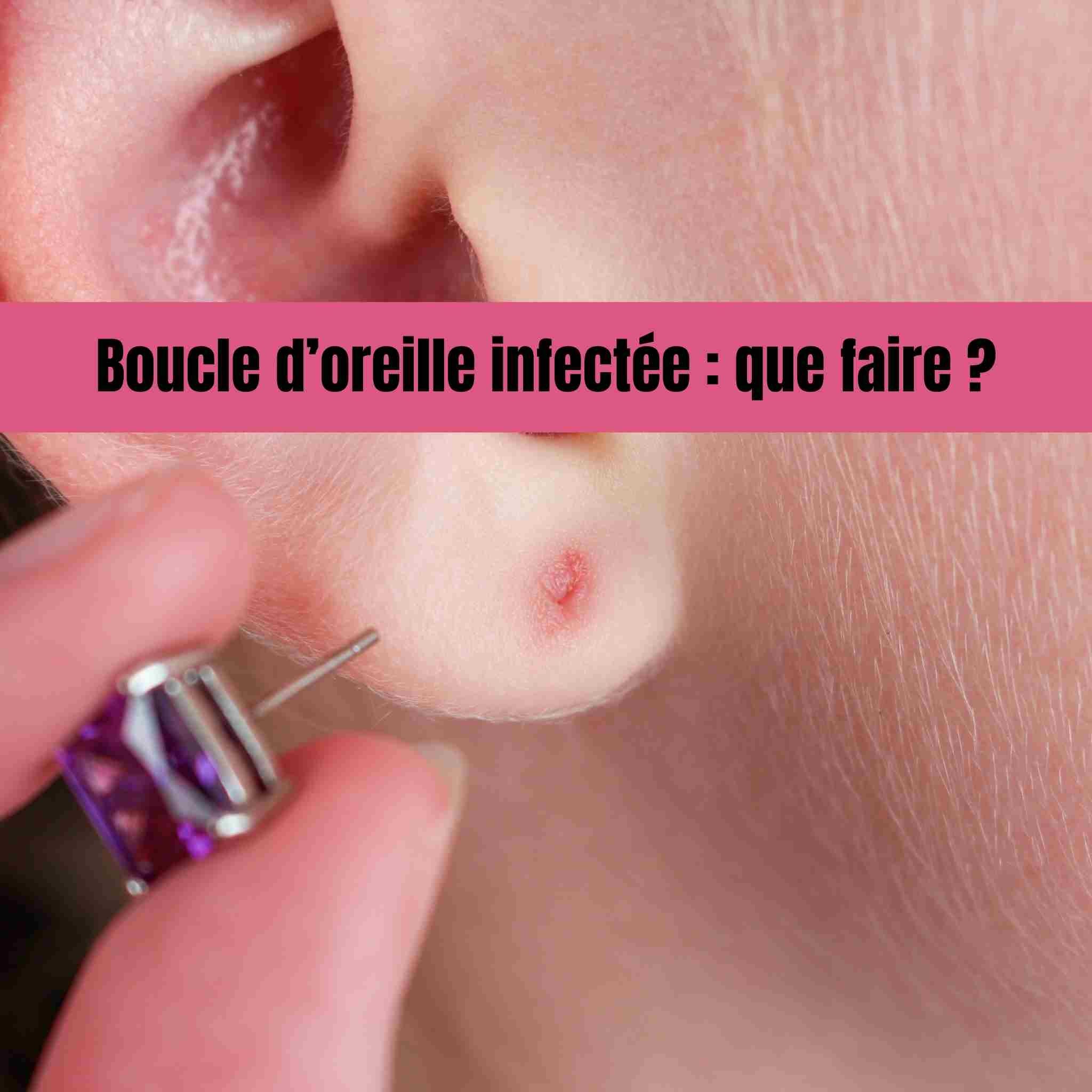Boucle d’oreille infectée : que faire et quand s’inquiéter ?