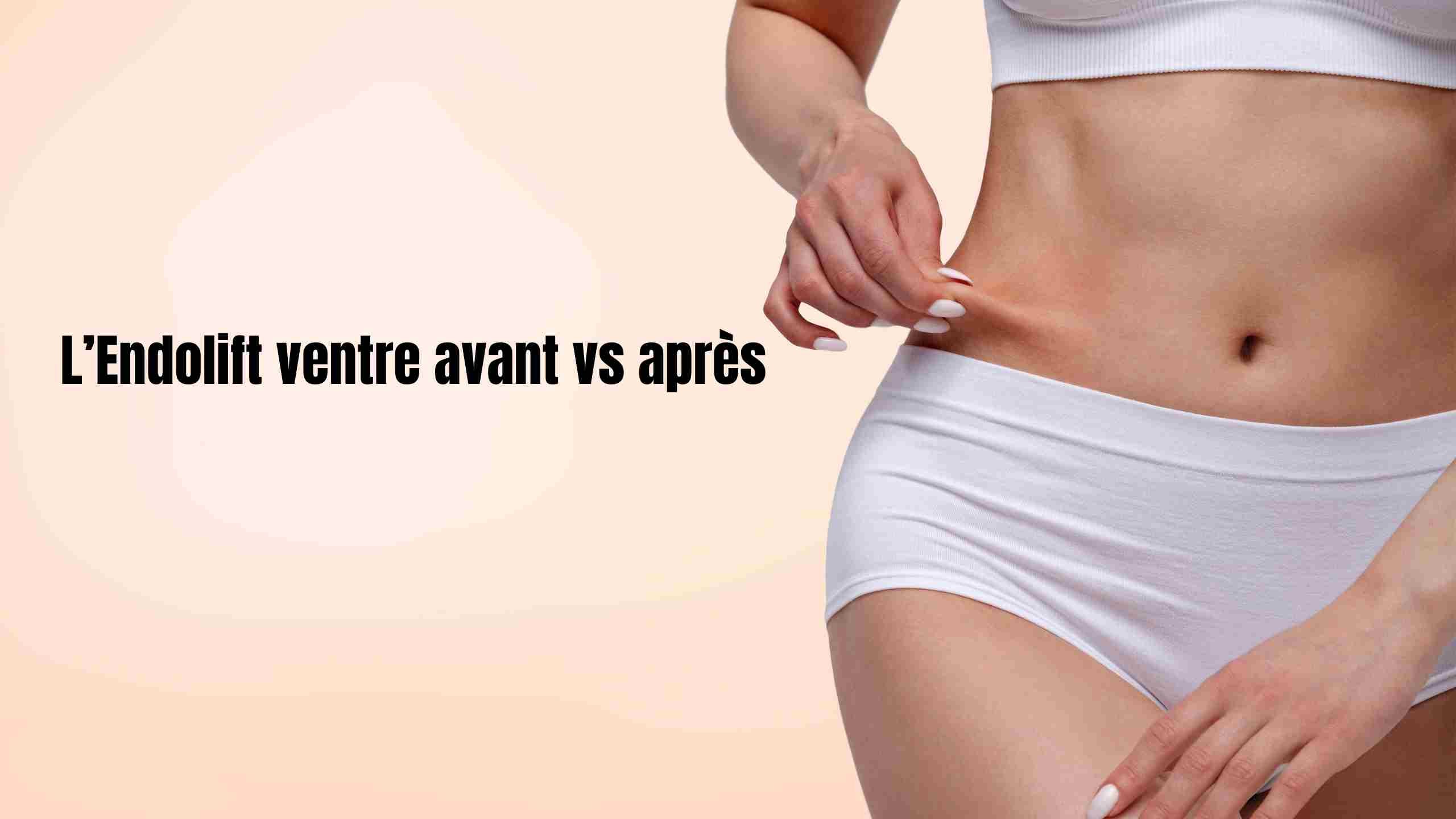 L'endolift ventre avant vs après: Tout comprendre