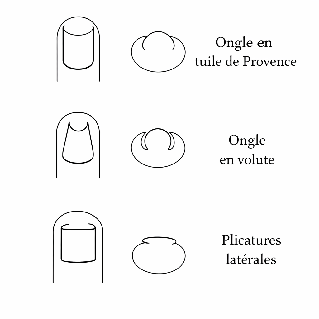 Ongle en tuile de Provence : causes, solutions et traitements