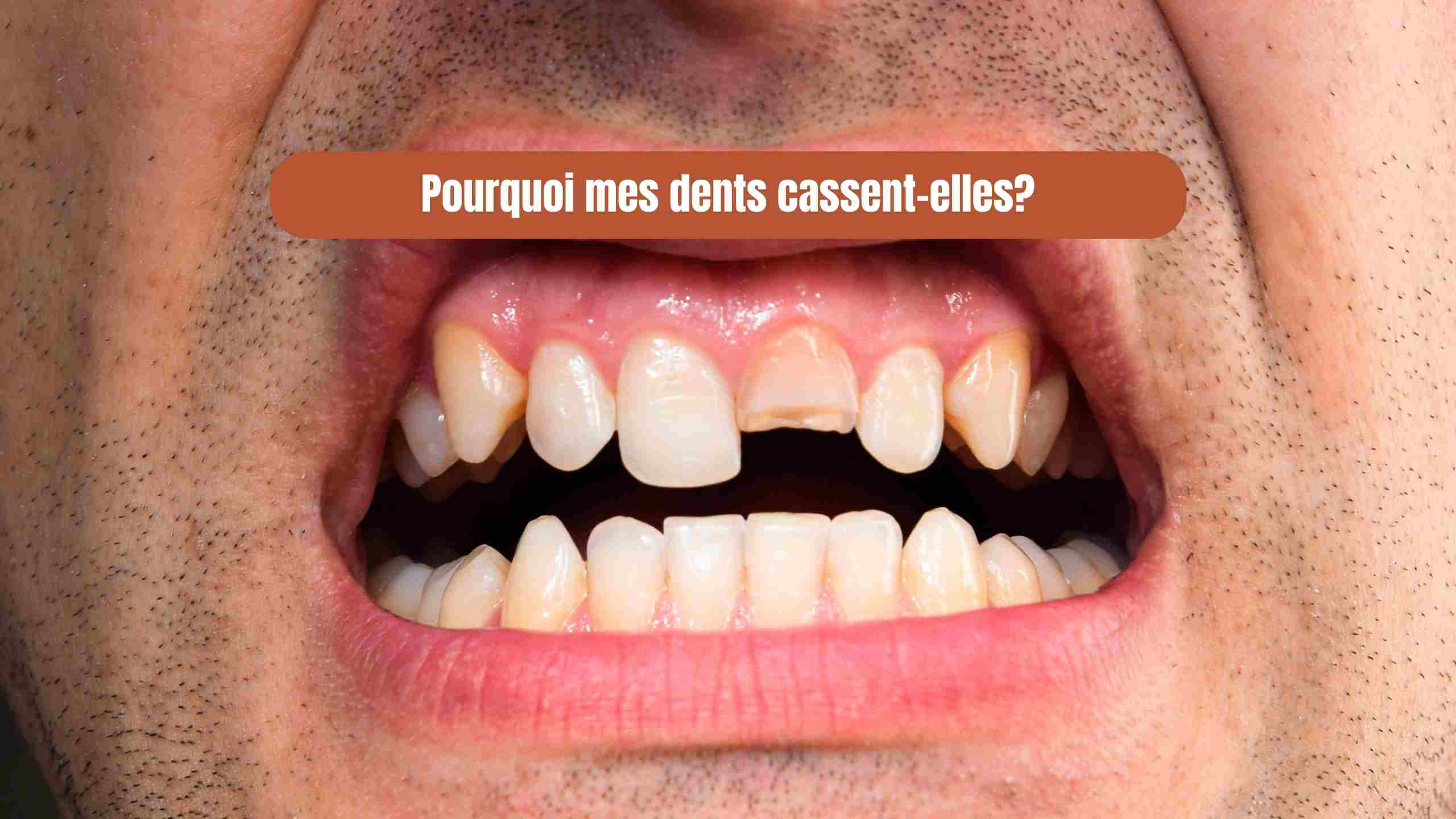Pourquoi mes dents se cassent-elles ? Causes, carences et solutions