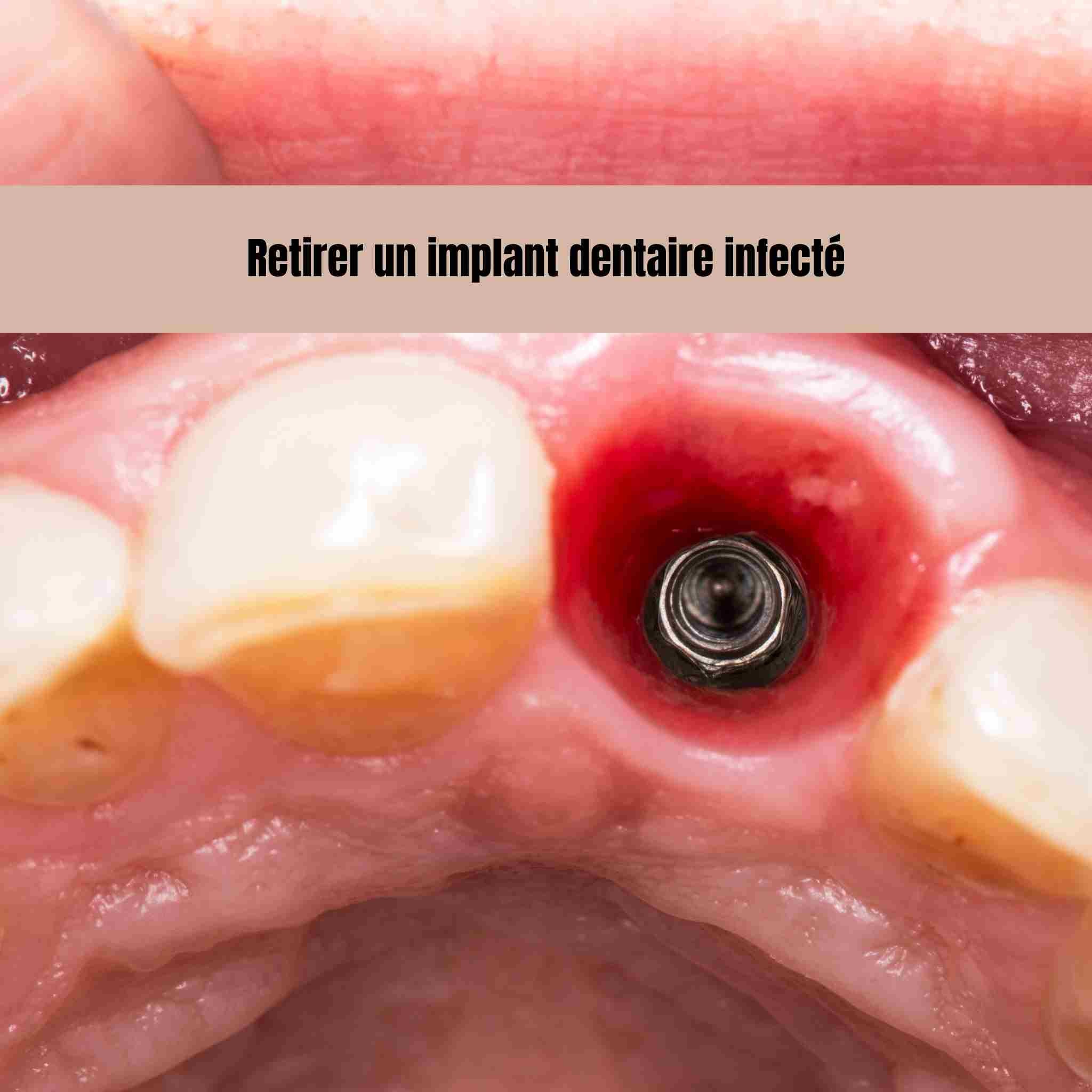 Retirer un implant dentaire infecté: ce qu’il faut savoir