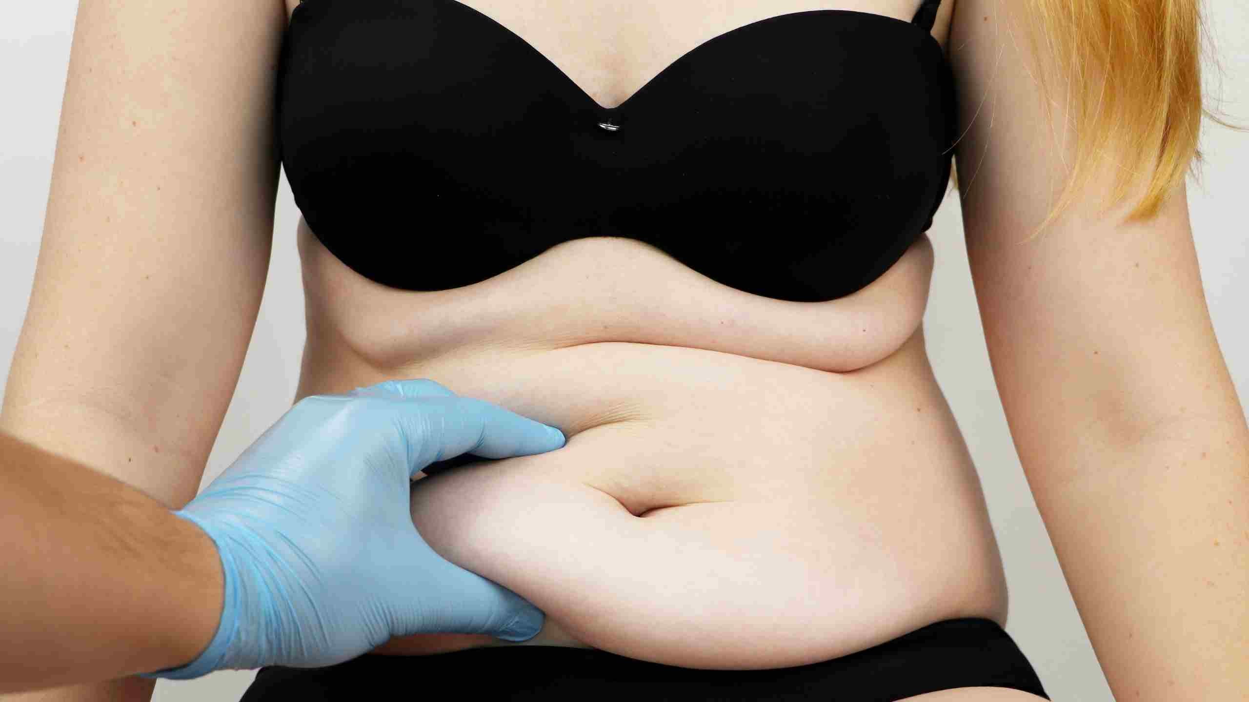 Découvrez tout sur l'abdominoplastie : tarifs, douleur, cicatrices, et résultats