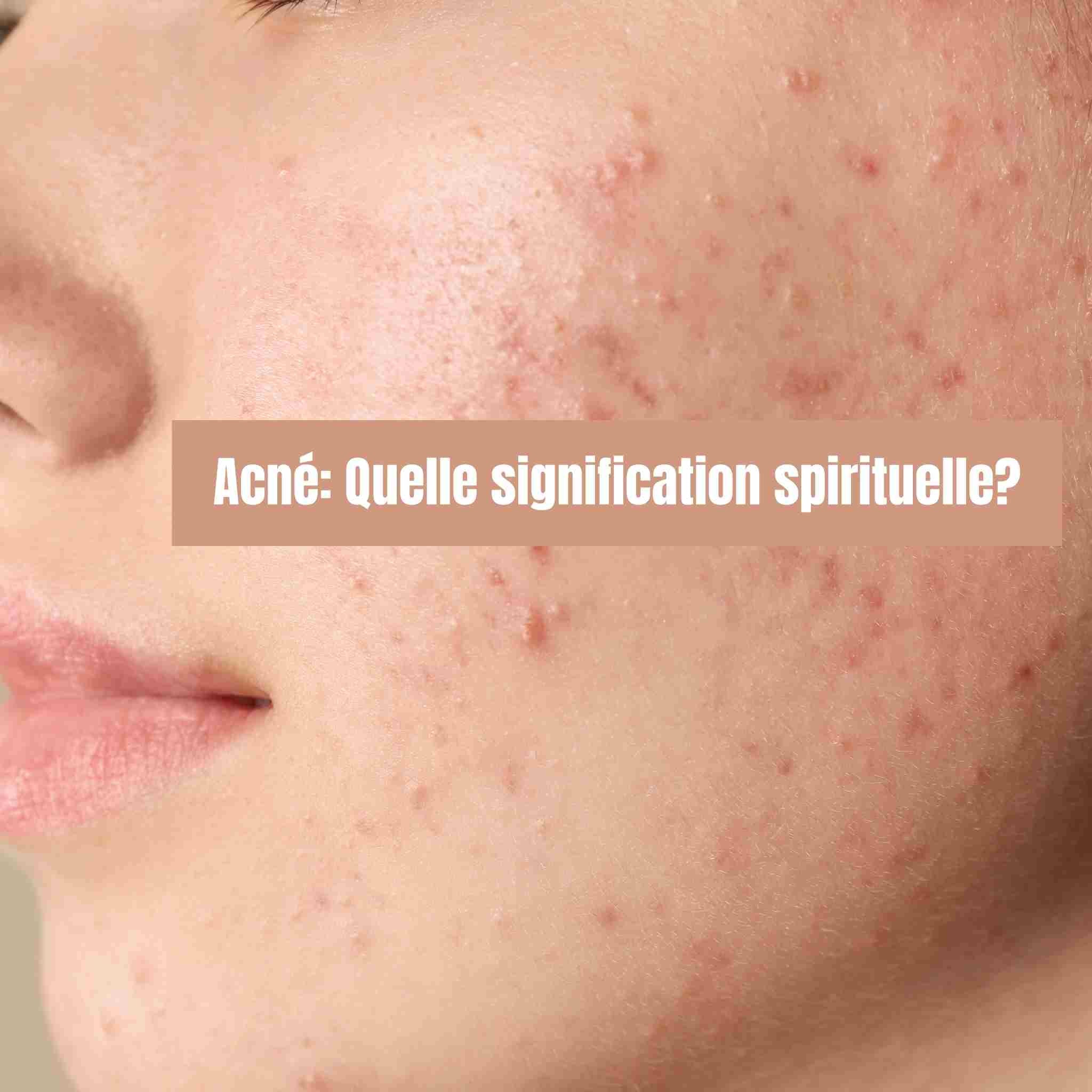 Acné: Quelle signification spirituelle? ce que le corps essaie de dire