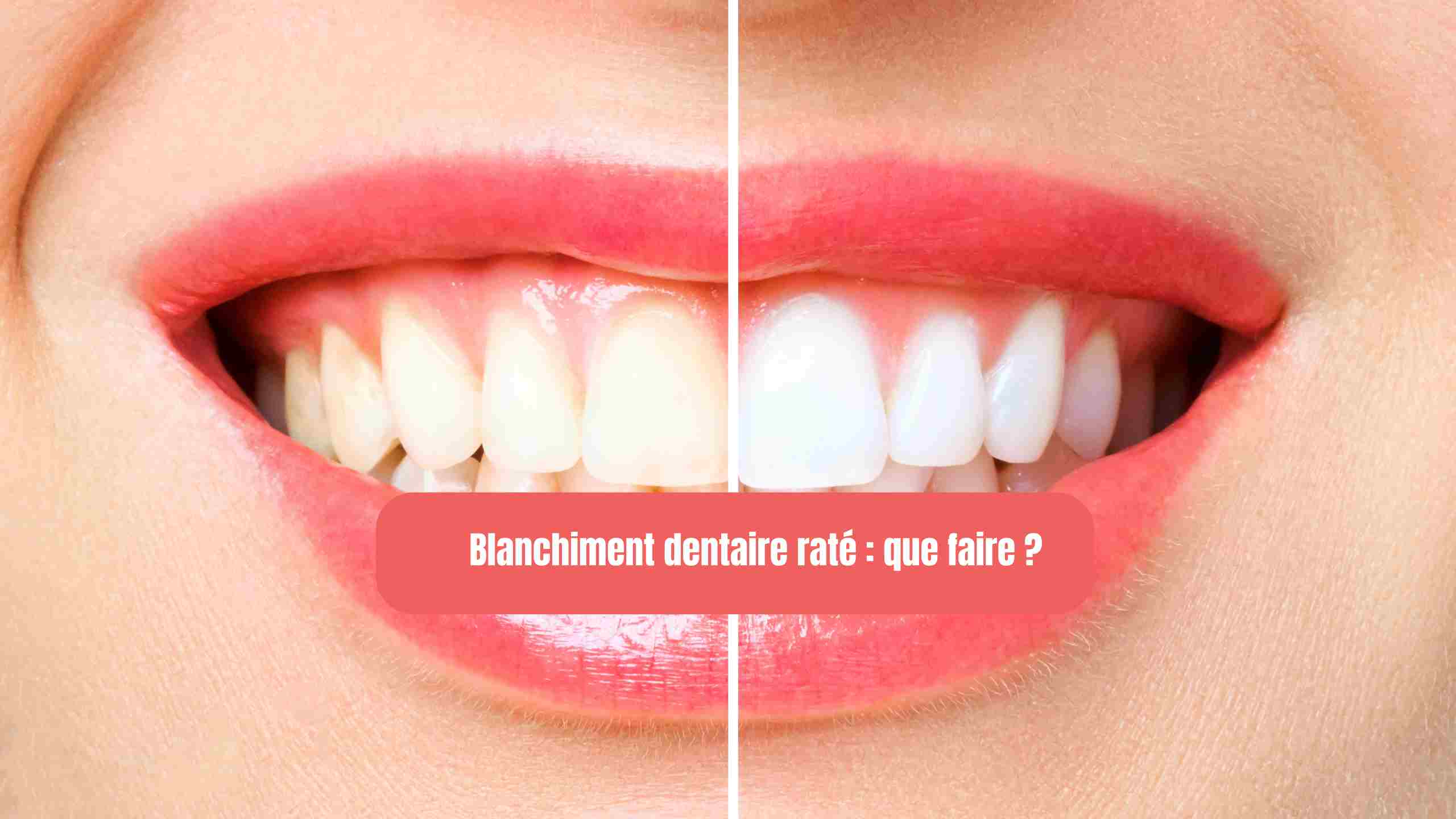 blanchiment dentaire rate que faire