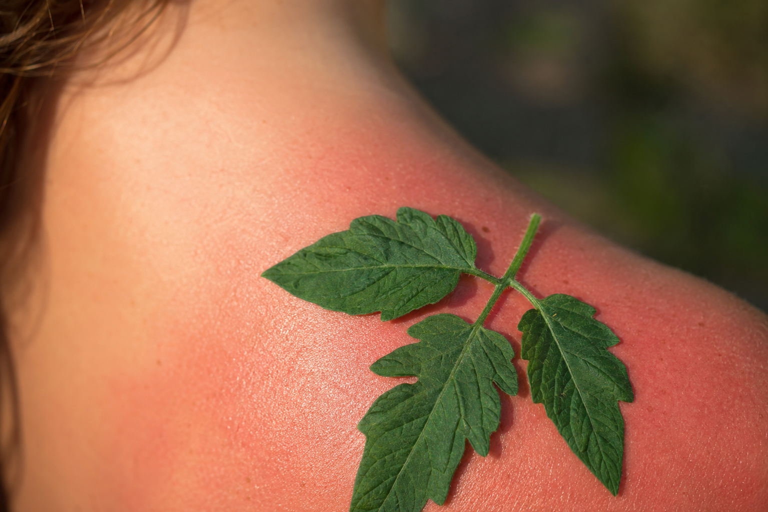 Brûlure de coup de soleil : une feuille de tomate peut-elle vraiment soulager ?