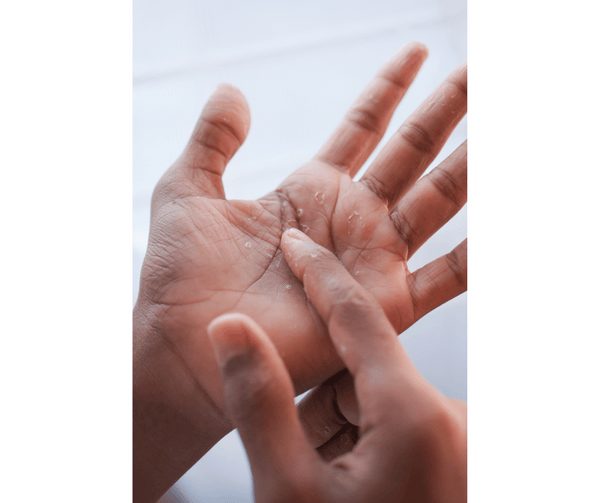 Comment soigner une crevasse au doigt grâce à un remède de grand-mère?