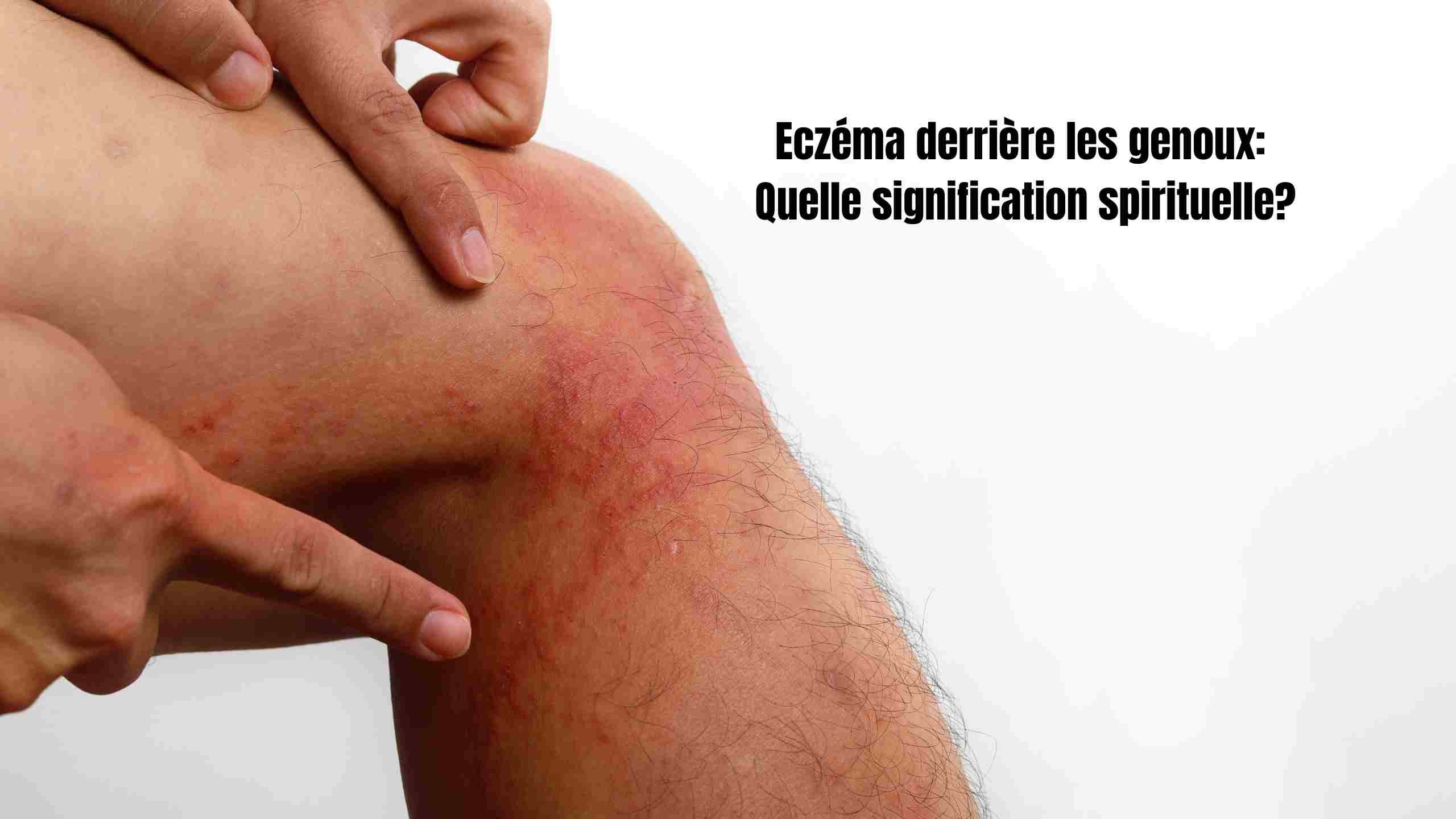 Eczéma derrière genoux: Quelle signification spirituelle?