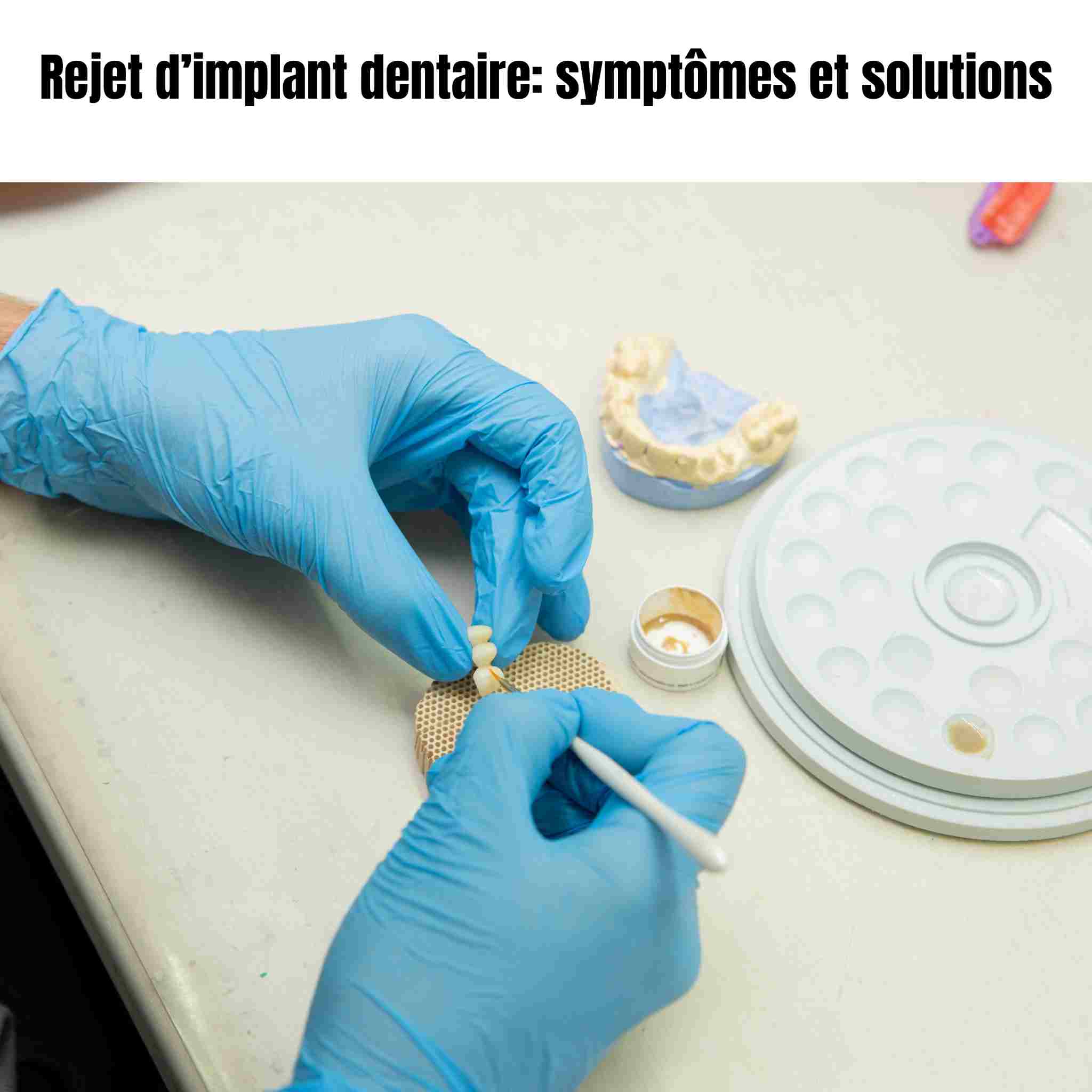 Rejet d’implant dentaire : symptômes, risques et complications