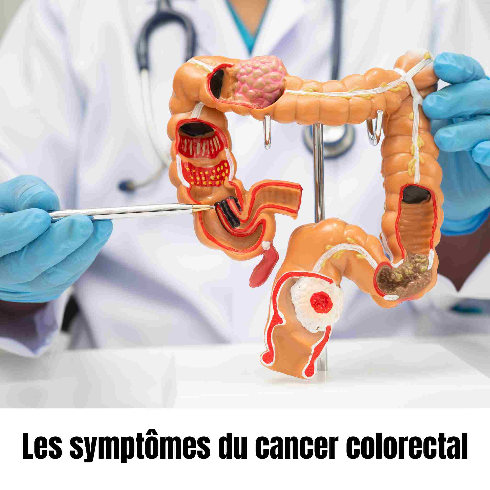 symptômes cancer colorectal