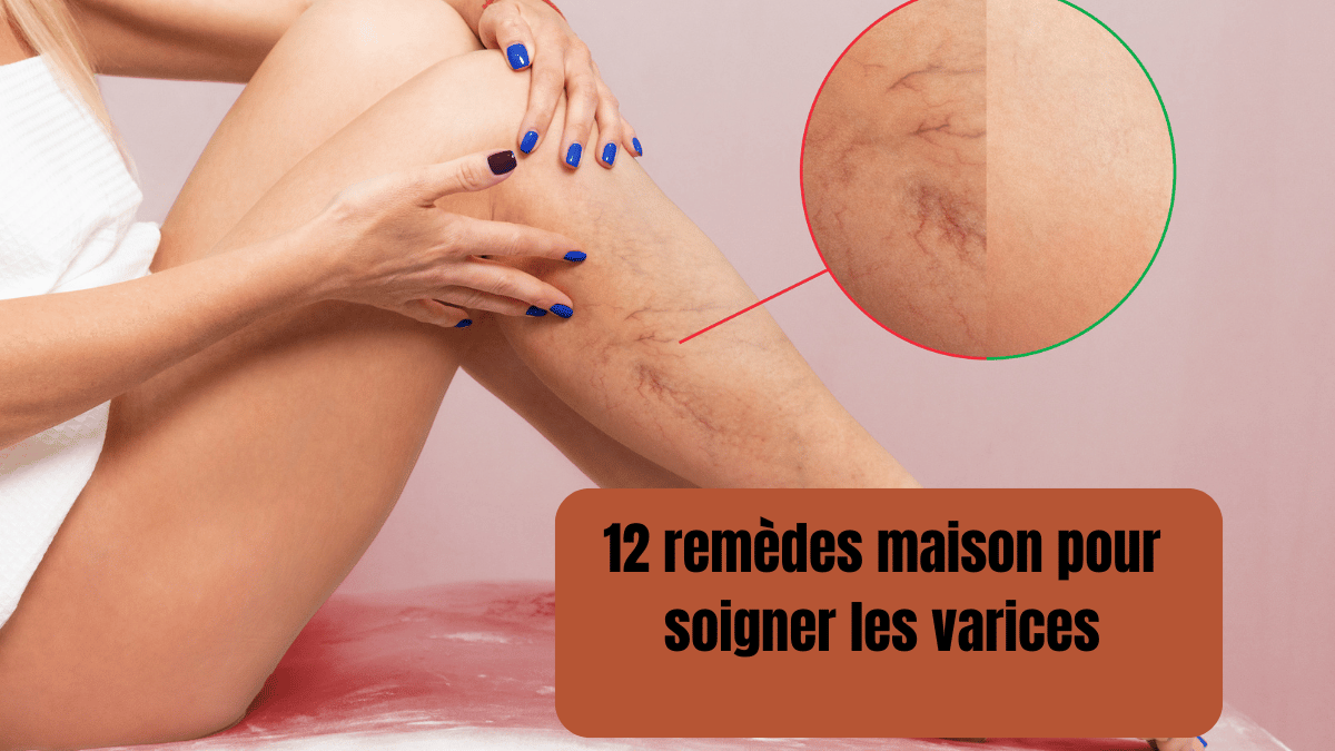 12 remèdes maison pour soigner les varices