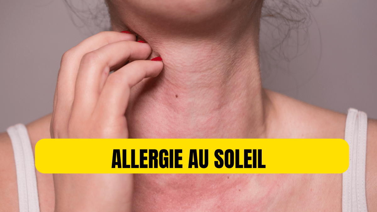 Allergie au soleil : Découvrez les remèdes naturels