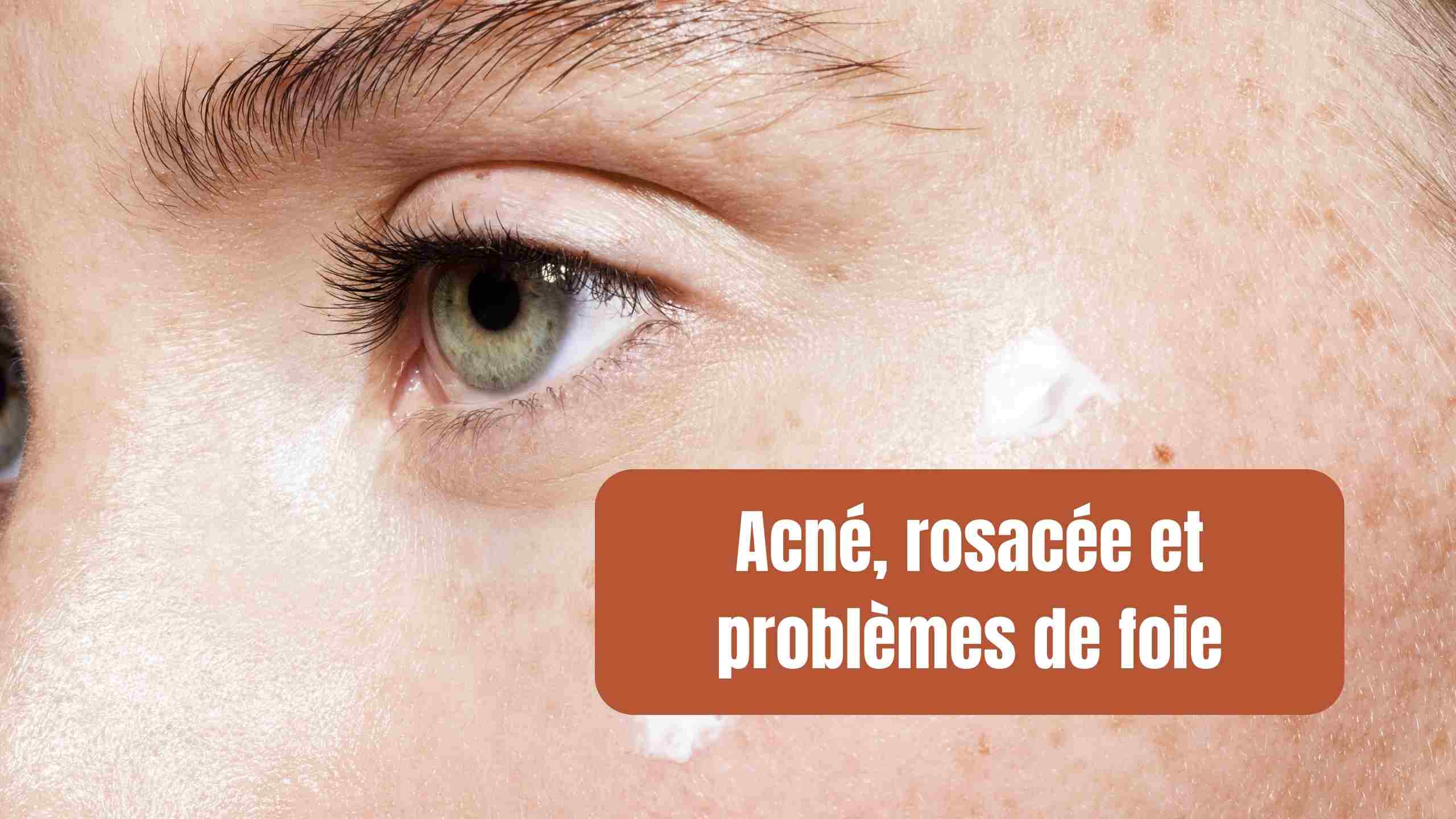 acné rosacée et problèmes de foie