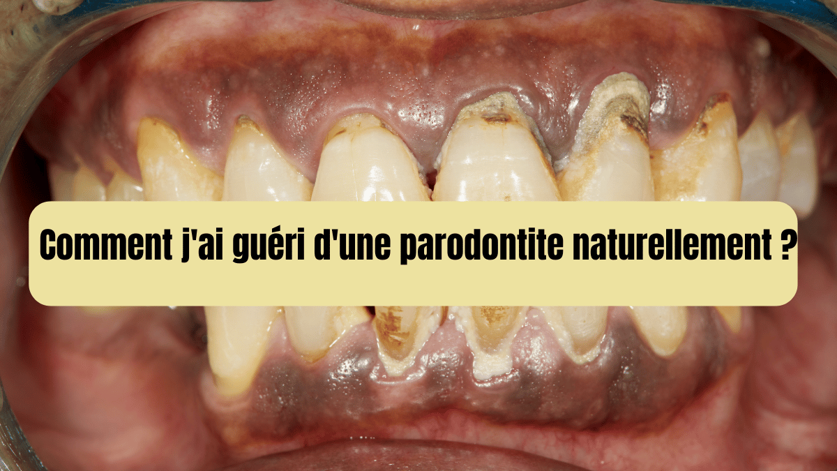 Comment j'ai guéri d'une parodontite naturellement: