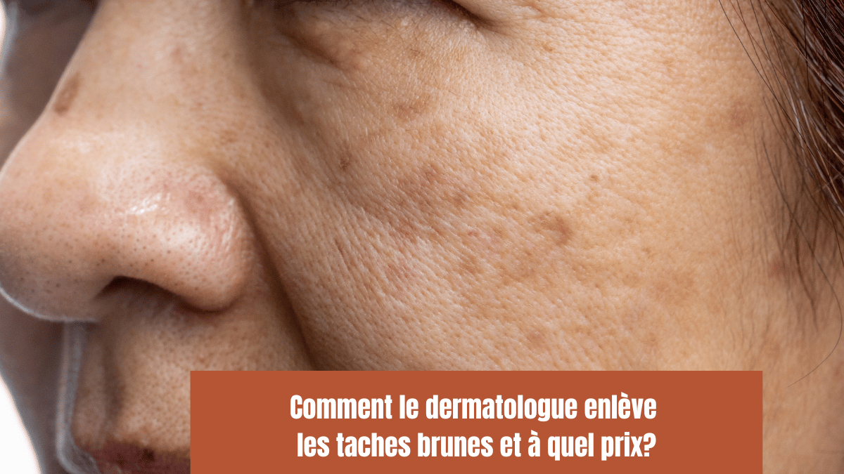 Comment le dermatologue enlève les taches brunes et à quel prix