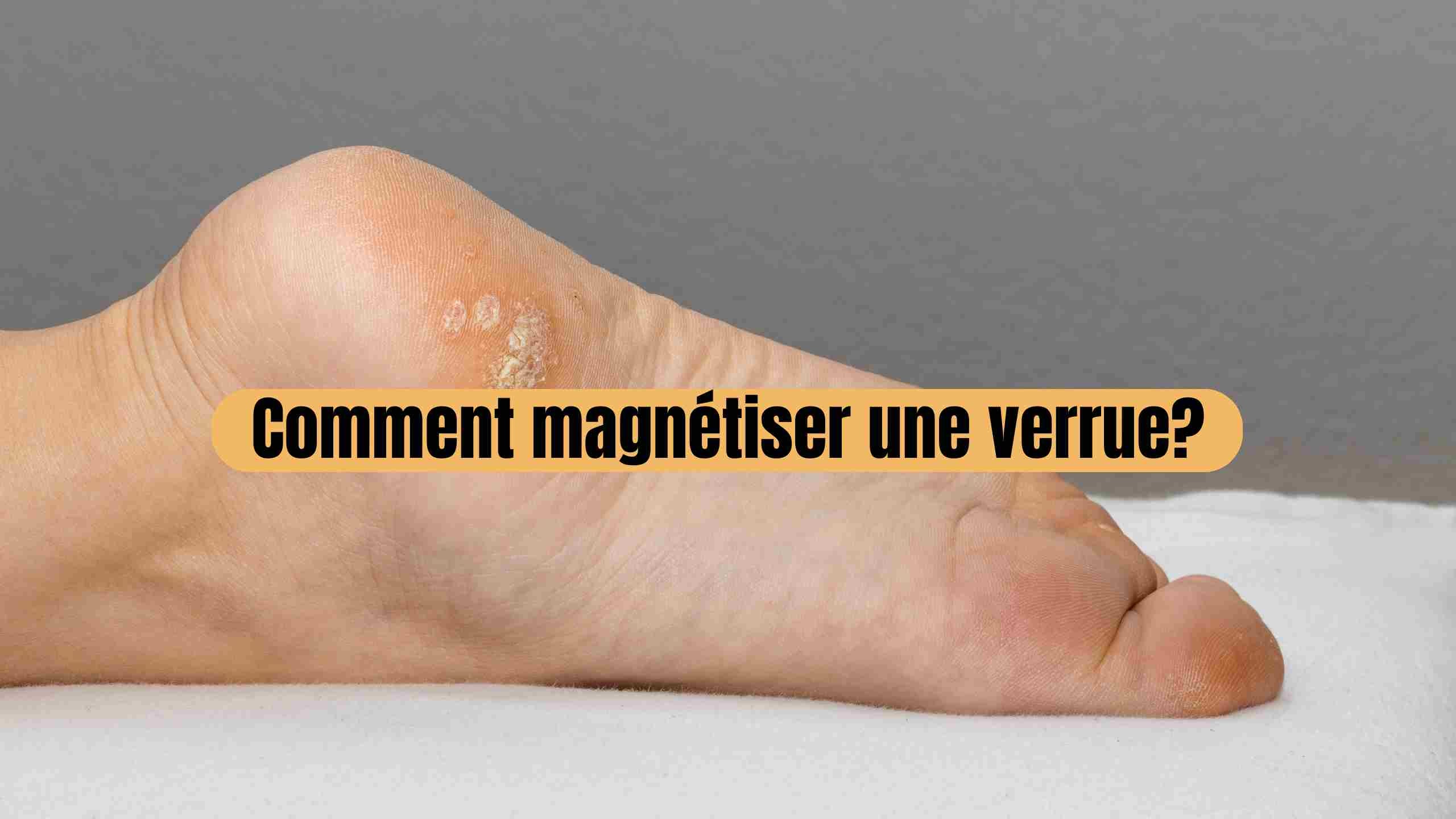 Comment magnétiser une verrue?