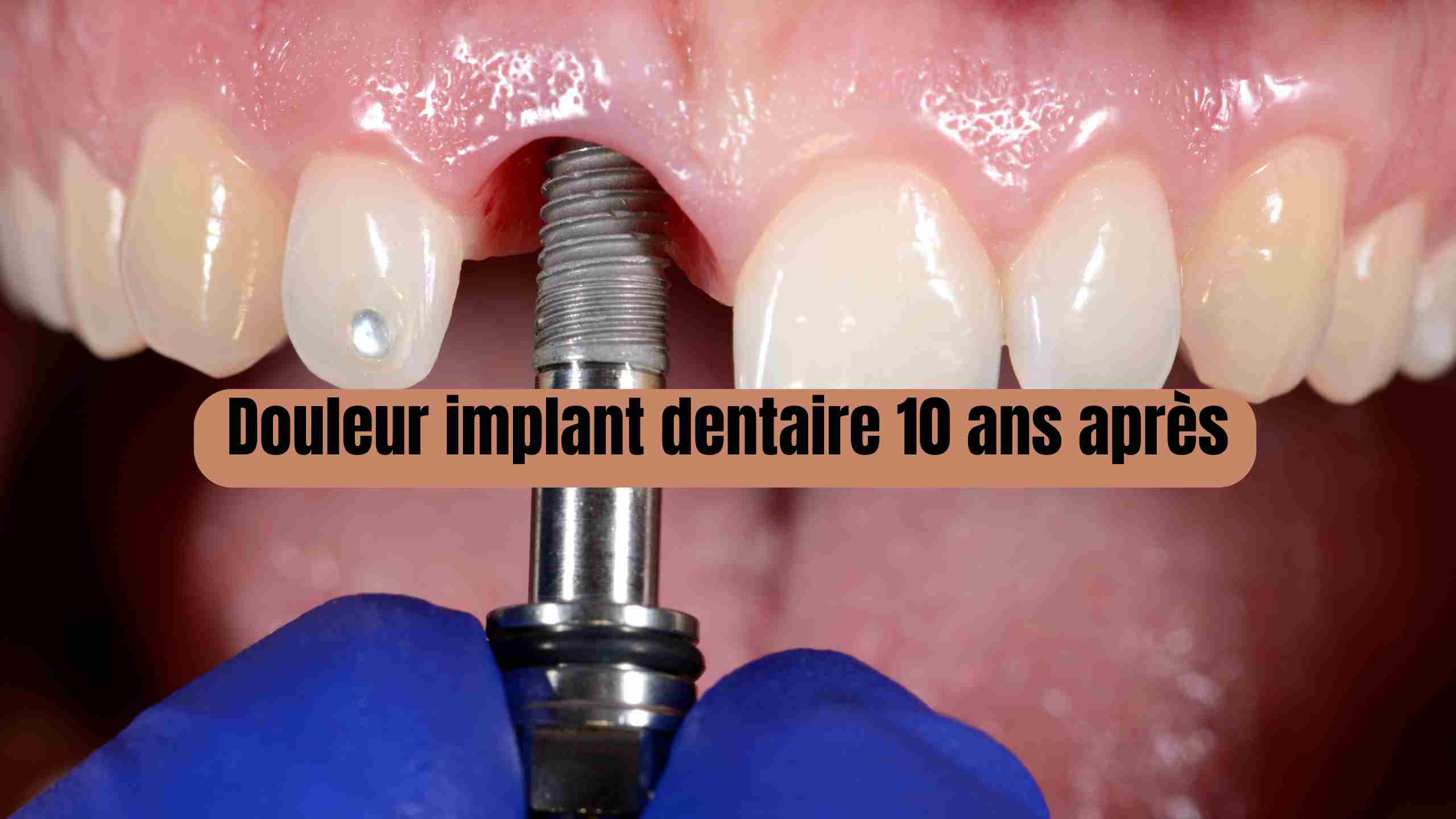 douleur implant dentaire 10 ans après