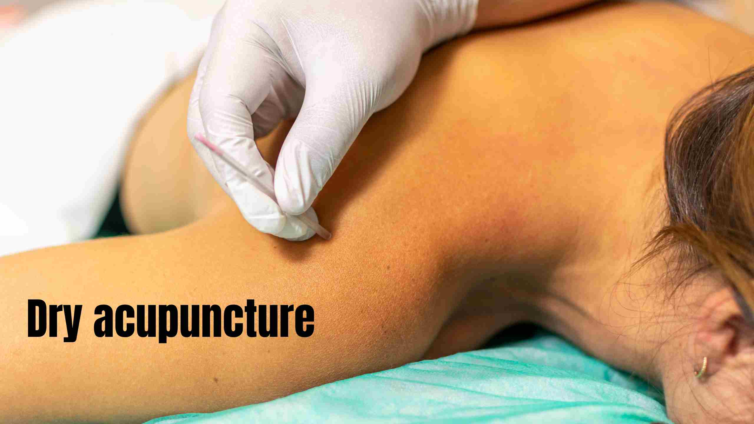 dry acupuncture