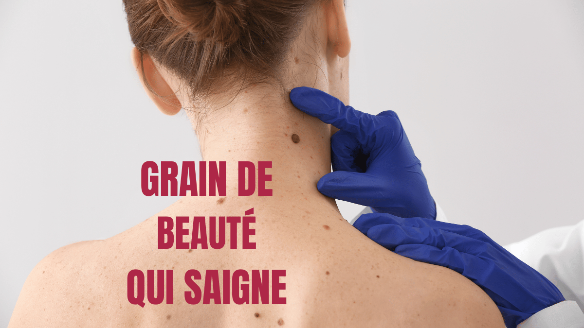 Que faire pour un grain de beauté qui saigne?