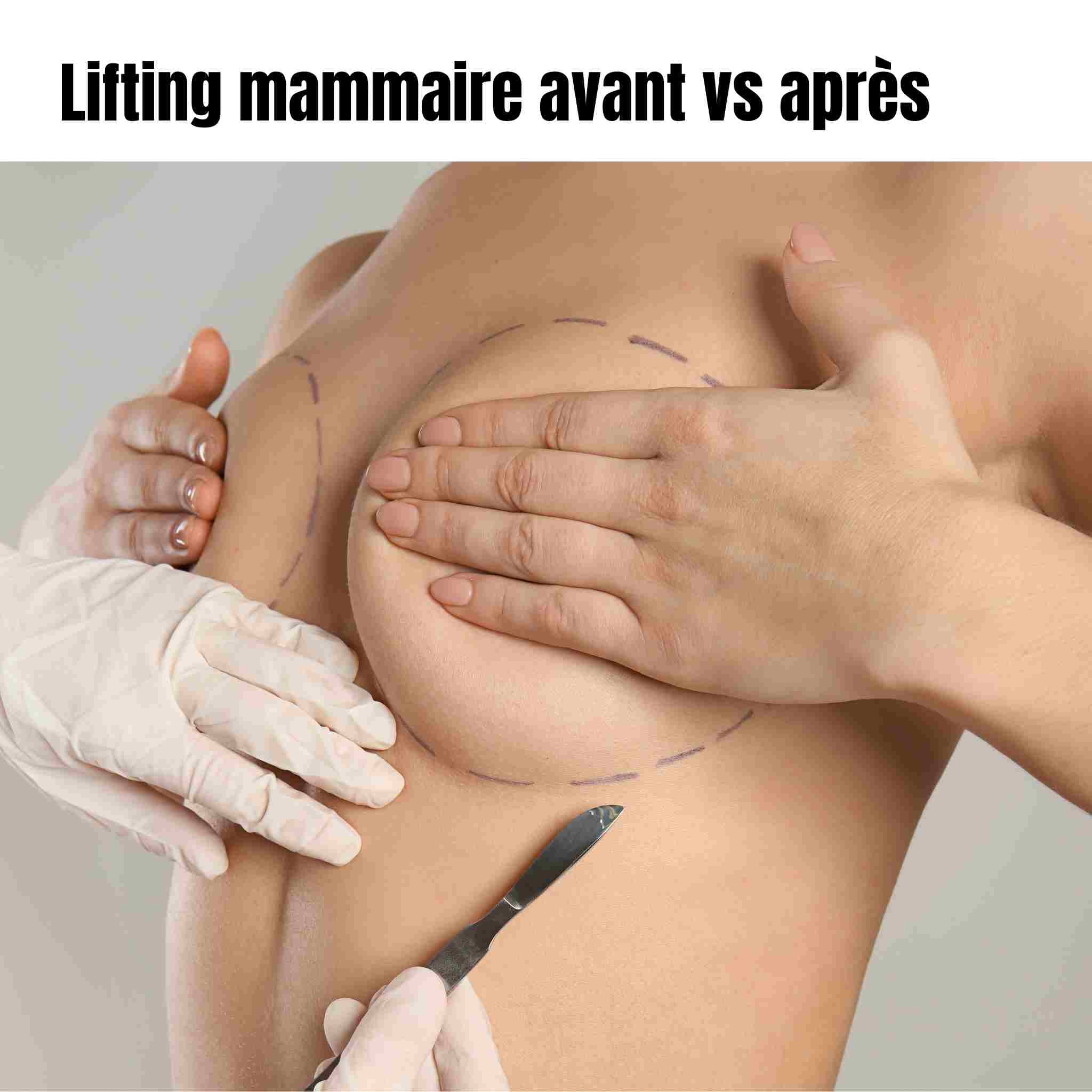 Avant / après lifting mammaire (mastopexie)