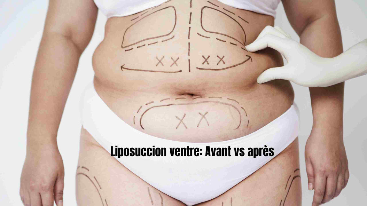 Liposuccion du ventre : Prix, risques, efficacité et avant après