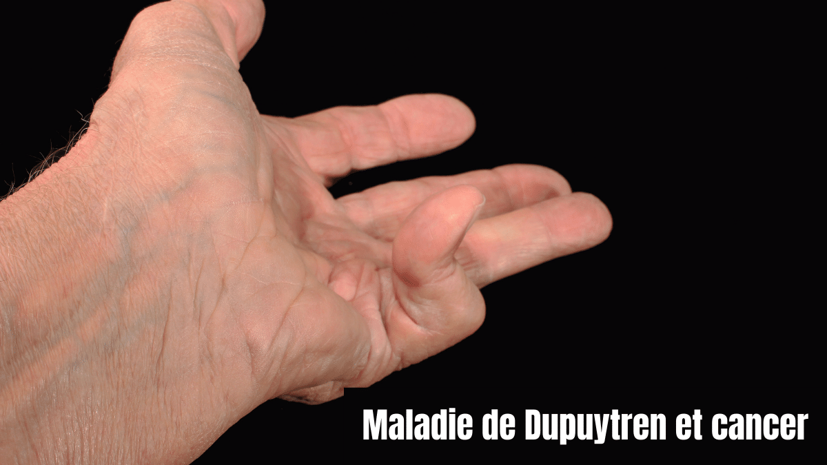 maladie de dupuytren et cancer