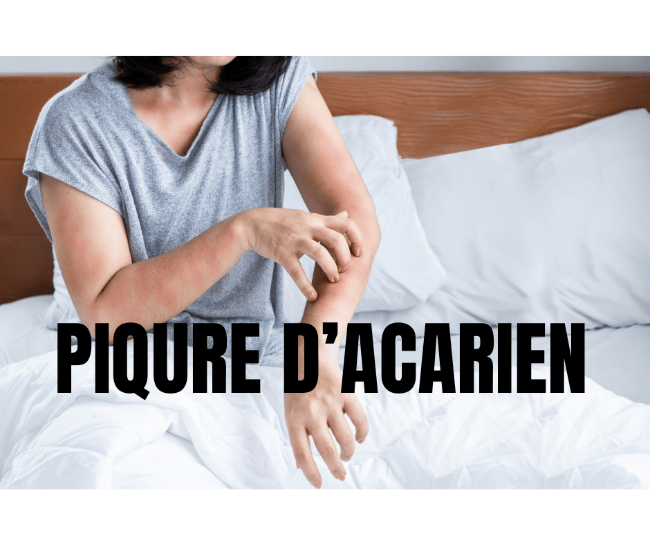 PIQURE D'ACARIEN