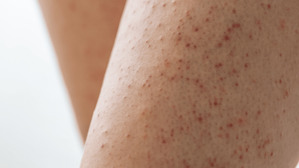 Comment Enlever La Peau De Fraise Sur Les Jambes Peau de fraise sur la jambe: Comment l'enlever?