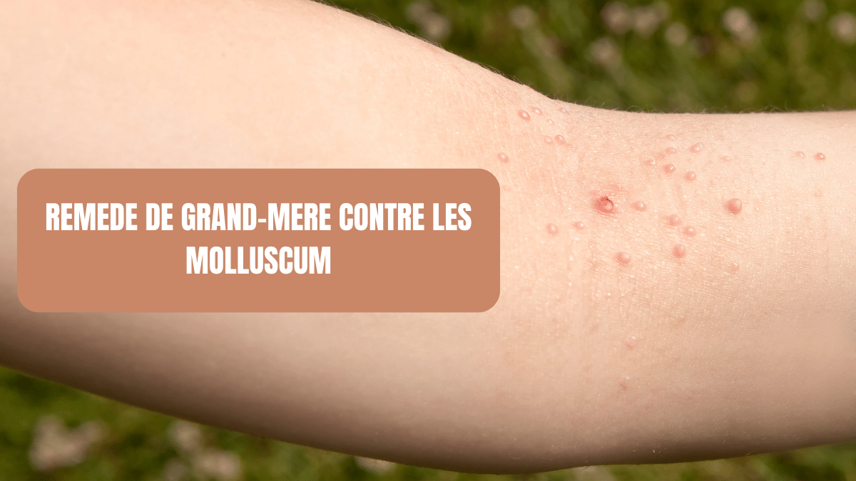 remede de grand mere contre les molluscum