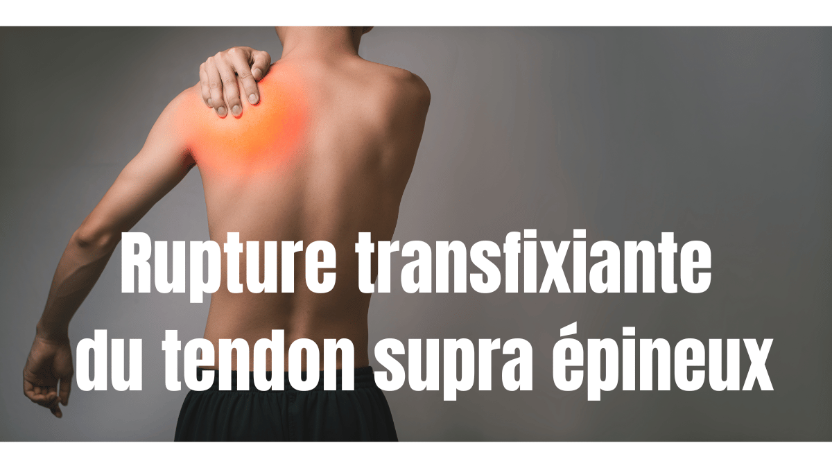 Le traitement d'une rupture transfixiante du tendon supra épineux