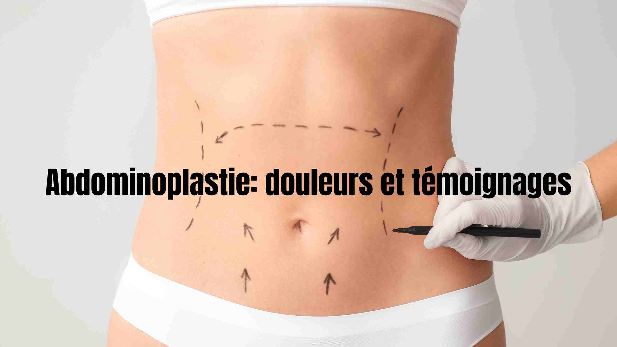 abdominoplastie-douleur-temoignage