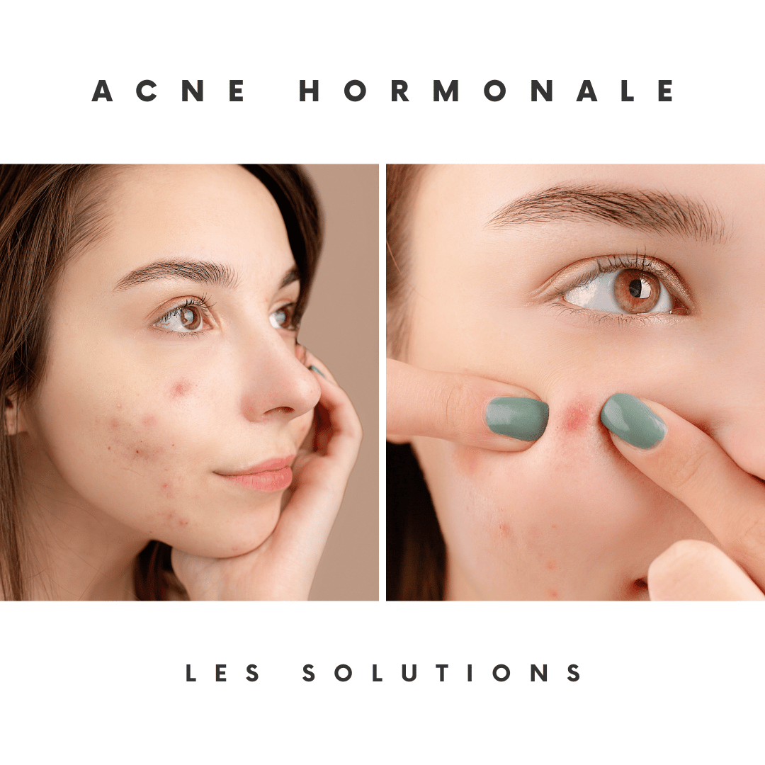 acne hormonale