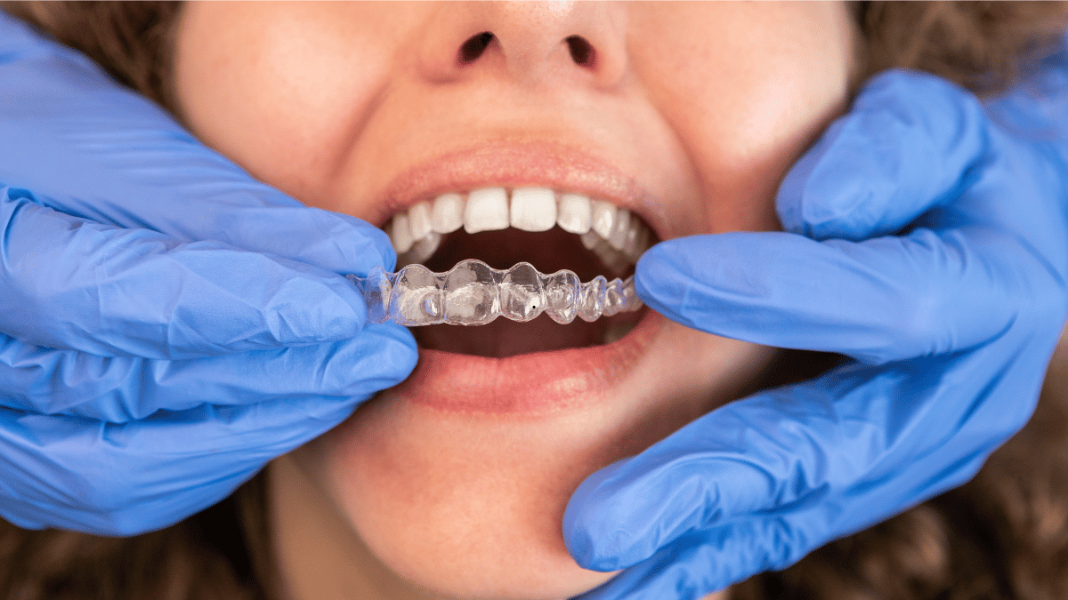 aligner ses dents