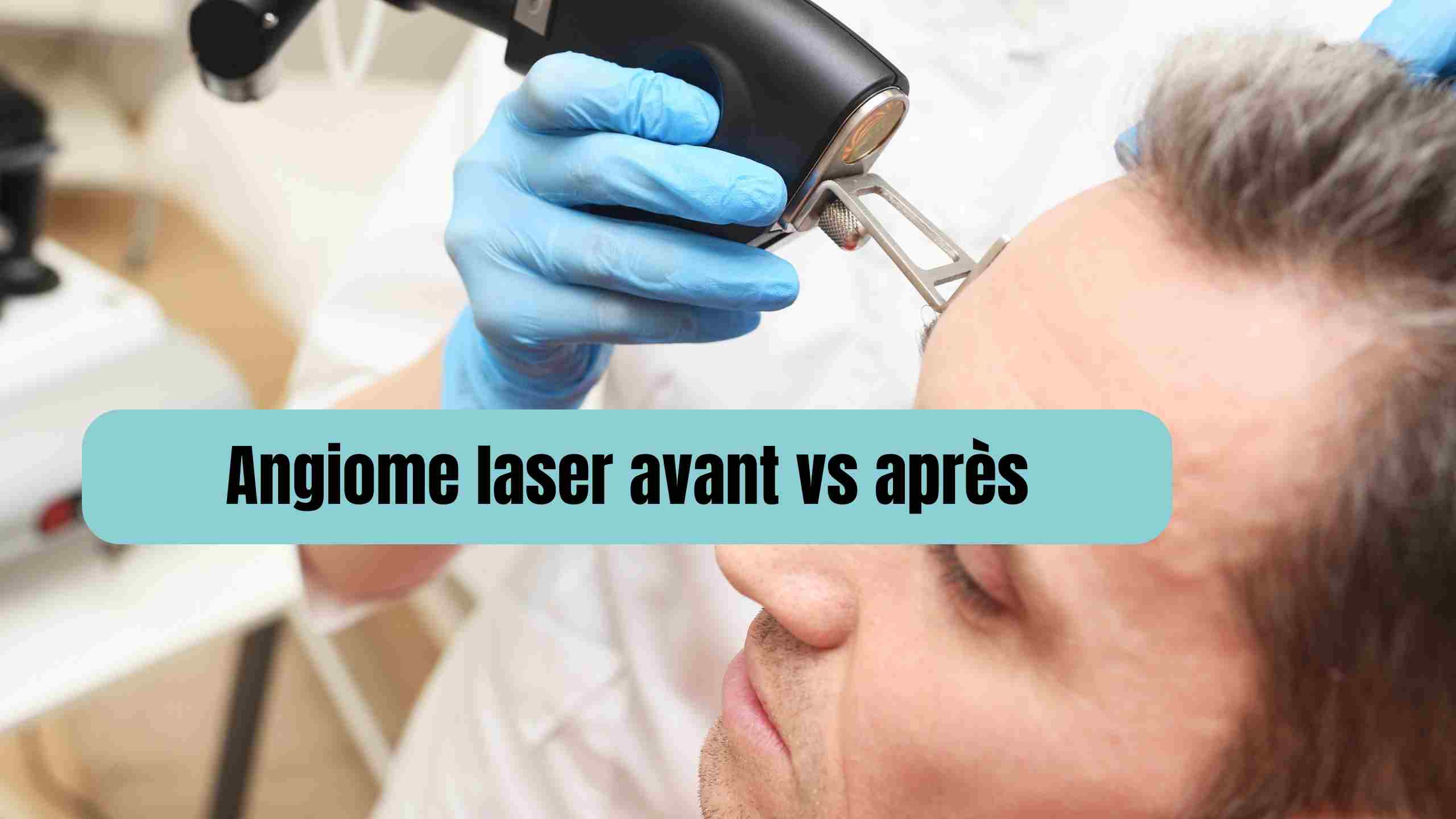 angiome laser avant apres