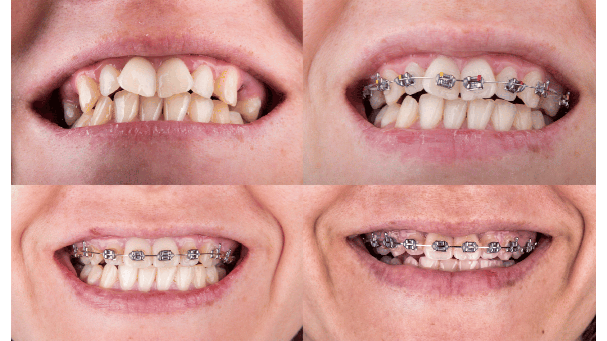 Résultat orthodontique adulte