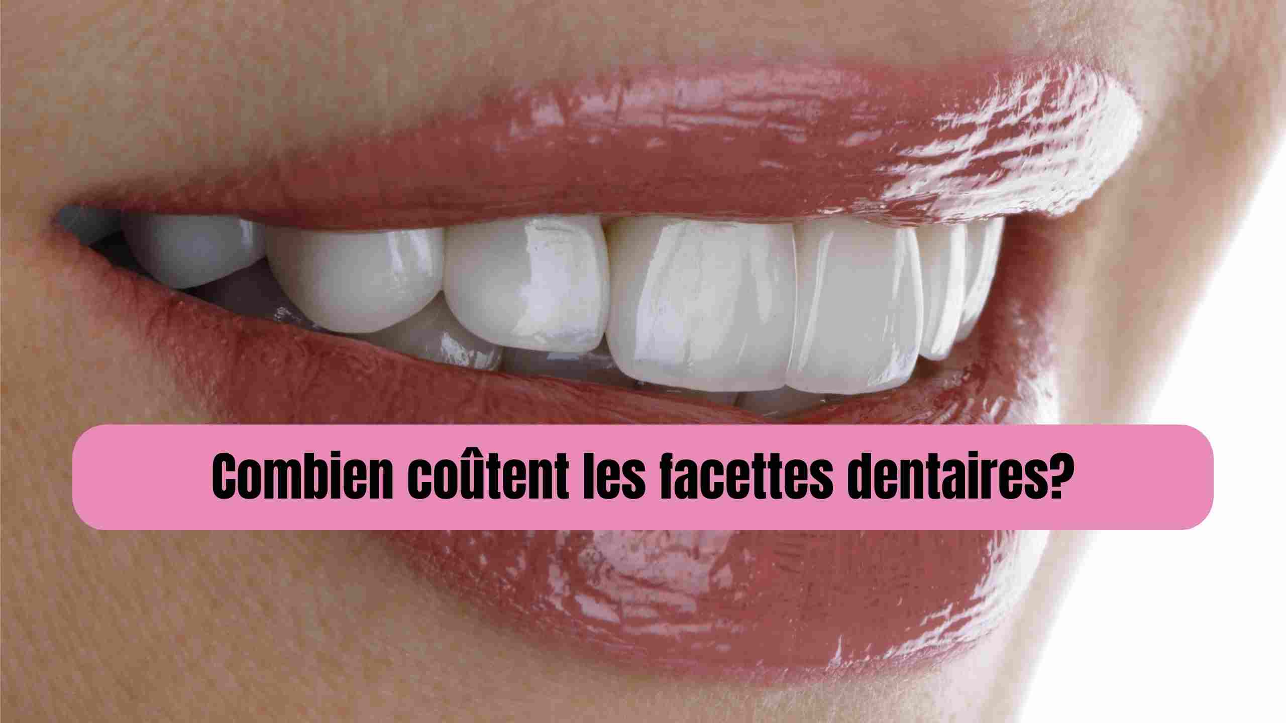 combien coute des facettes dentaires