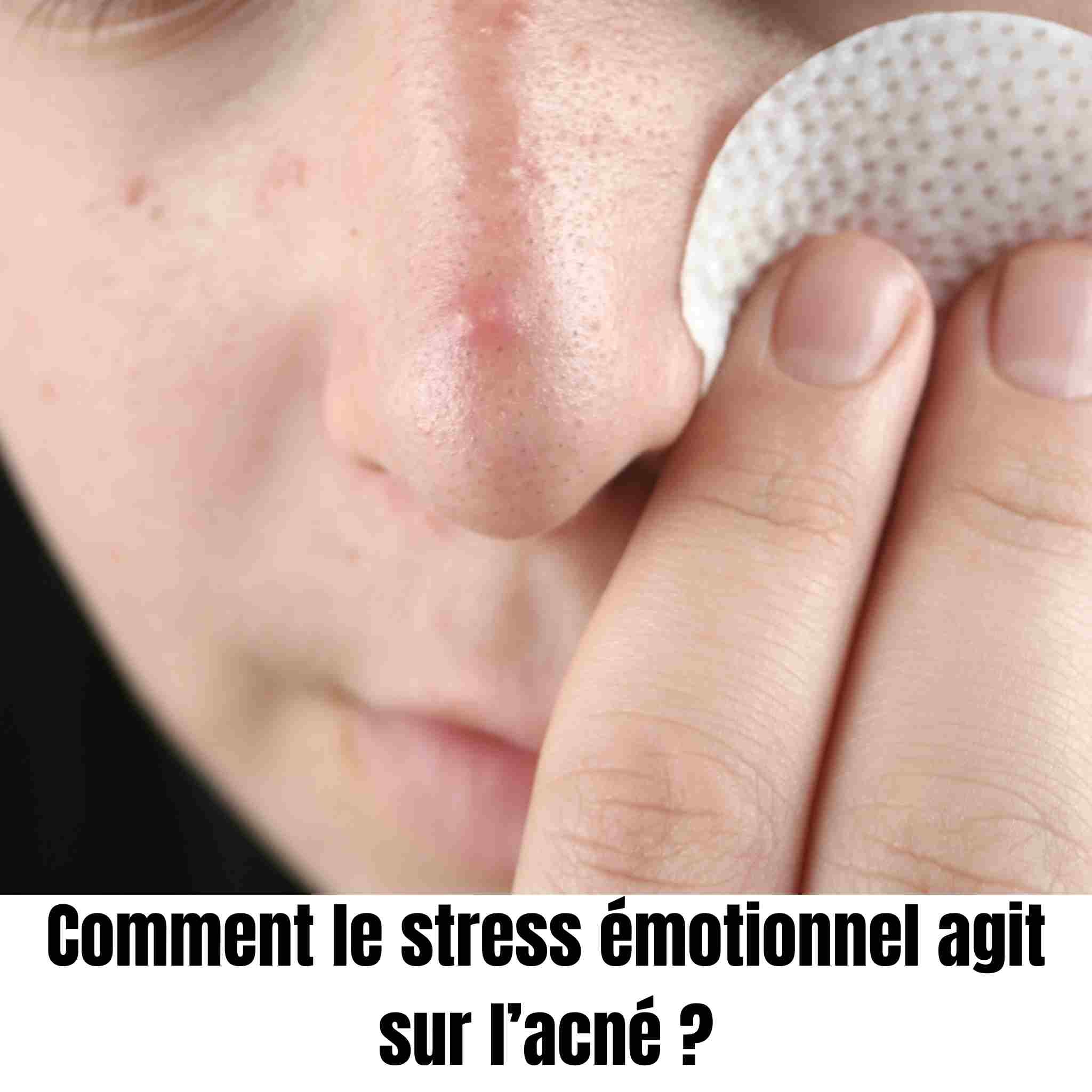 Comment le stress émotionnel agit sur l’acné ?