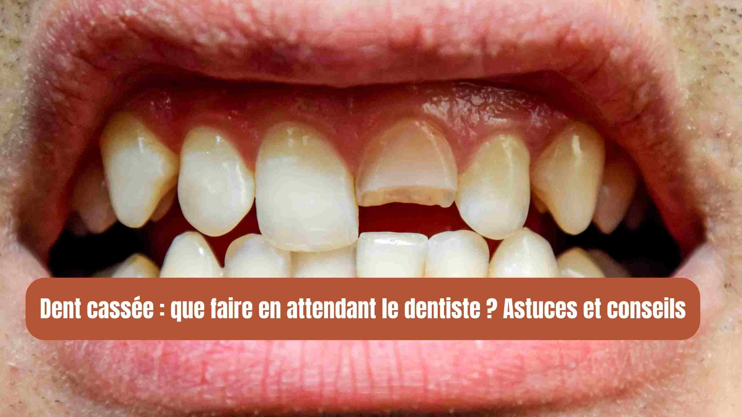 Dent cassée : que faire en attendant le dentiste ? Astuces et conseils