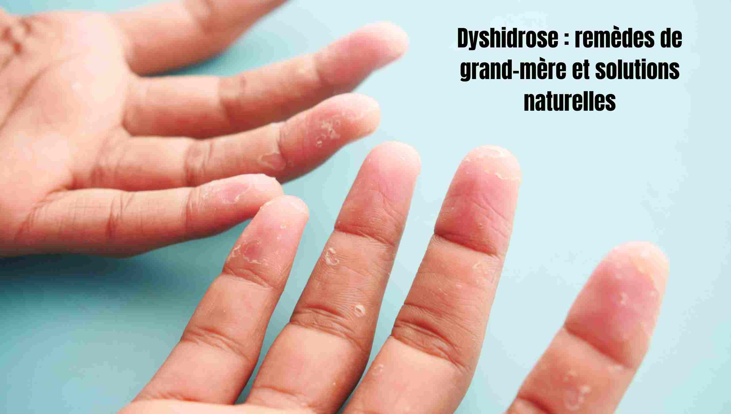 Dyshidrose : remèdes de grand-mère et solutions naturelles