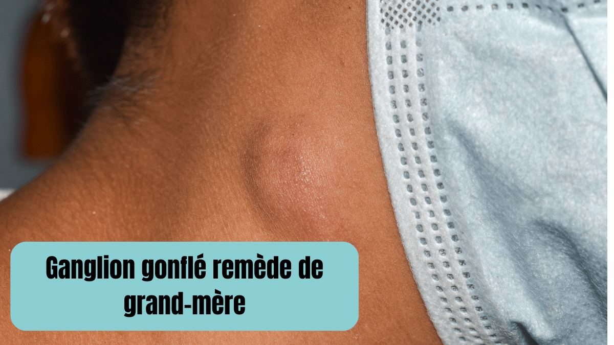 ganglion gonfle remede de grand mere