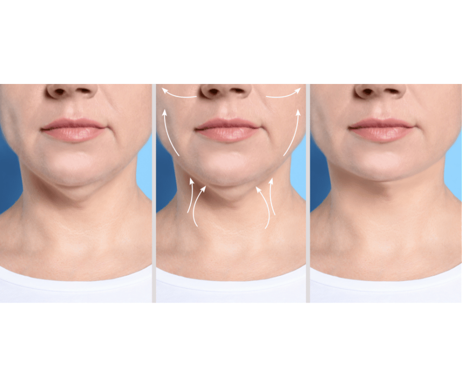 gua sha double menton