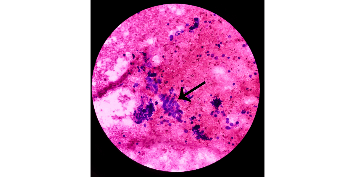 Le traitement naturel de l'histiocytofibrome