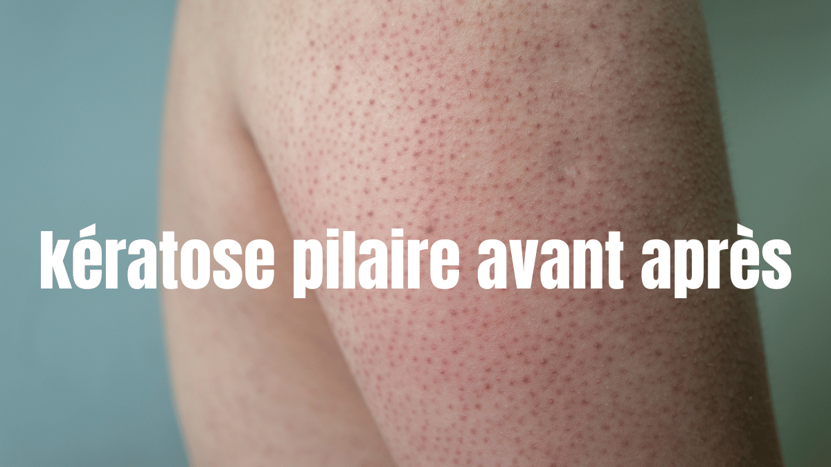 kératose pilaire avant après