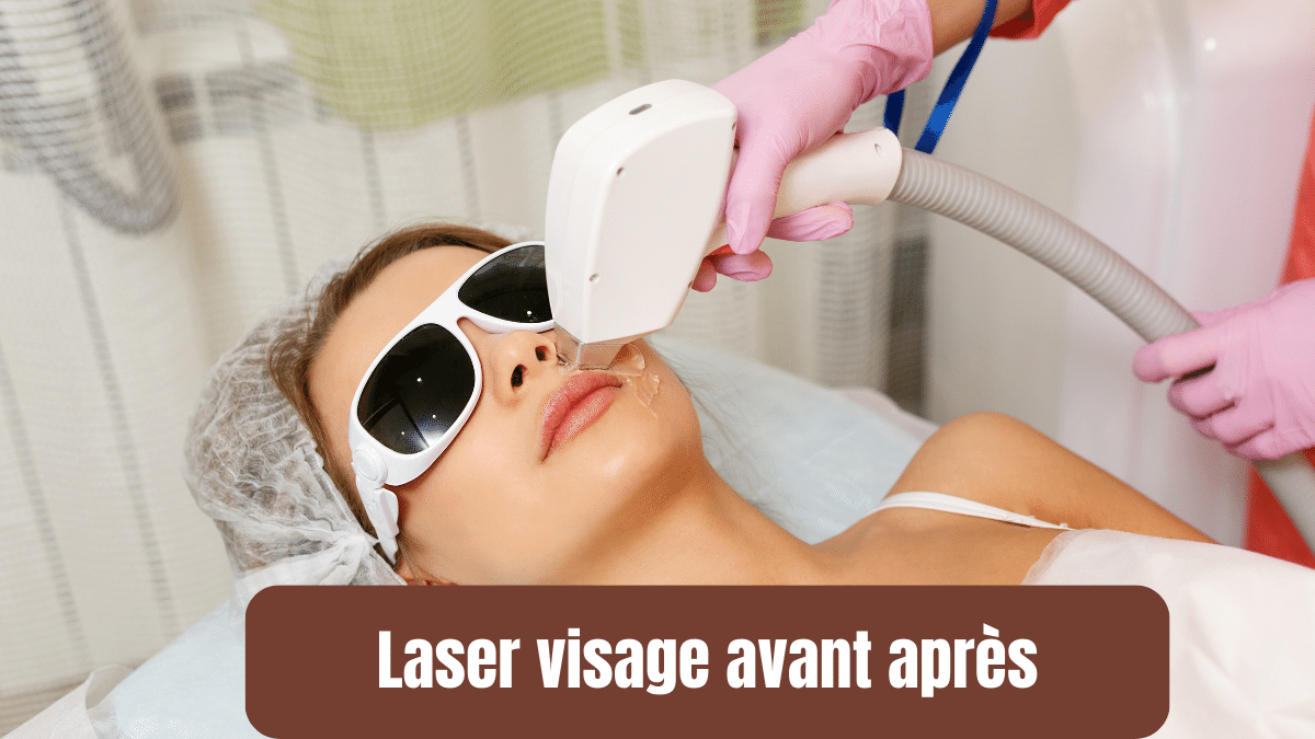 laser visage avant apres