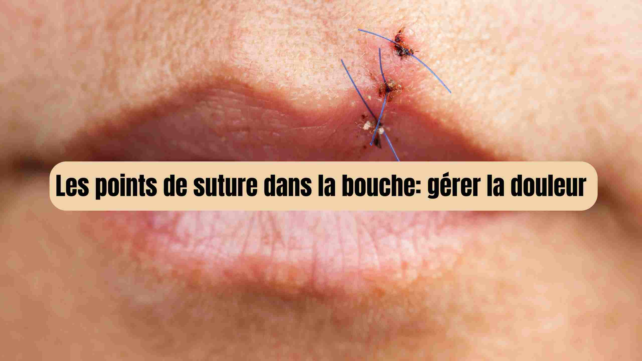 Points de suture dans la bouche : comment gérer la douleur ?